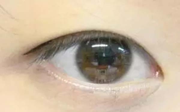 徐占峰醫(yī)師在深圳鵬愛醫(yī)院進行雙眼皮手術的效果如何？