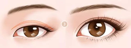 武漢美立方的胡江偉如何進(jìn)行雙眼皮手術(shù)？