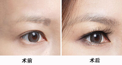 北京八大處醫(yī)院大牌醫(yī)生推薦！專治雙眼皮！