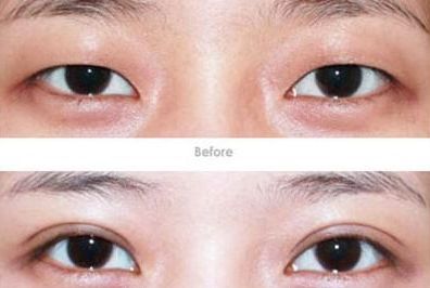 杭州開眼角醫(yī)生哪家好？專家推薦的杭州開眼角醫(yī)院排行榜