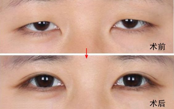 南京哪家醫(yī)院去眼袋好？眼袋手術(shù)選哪家醫(yī)院最好