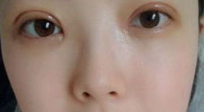 上海哪家醫(yī)院的雙眼皮手術(shù)效果最好？