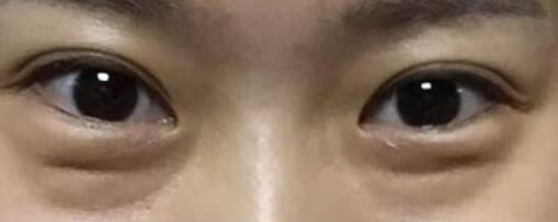 蘇薇潔與楊亞益哪位更適合做雙眼皮？上海美眼大咖實(shí)力測(cè)評(píng)揭曉，你怎么決策？