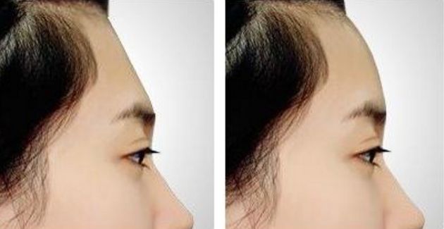 南京割雙眼皮哪家醫(yī)院效果好？