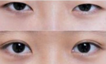 秦皇島雙眼皮哪家做的好？選擇前必看！