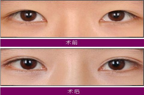 大連注射玻尿酸哪家醫(yī)院技術(shù)好，效果持久？