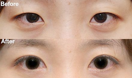 2023深圳黃金微針去除口周紋醫(yī)生綜合實(shí)力排行榜(鄭瑜璠、吳曉玲、劉彤大勢(shì)醫(yī)美重磅來(lái)襲)