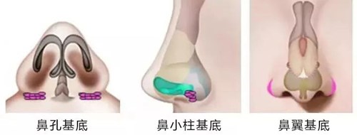 上海王艷醫(yī)生鼻部整形效果及價(jià)格匯總
