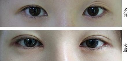 福州抽脂大腿哪家醫(yī)院好？挑選福州最靠譜的抽脂醫(yī)院有哪些？
