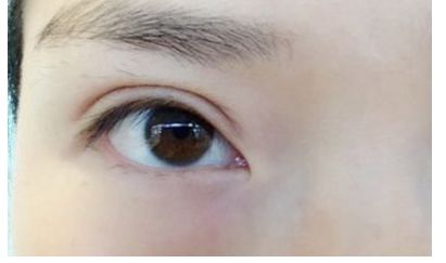 南昌祛痘哪家醫(yī)院口碑好，效果最佳？