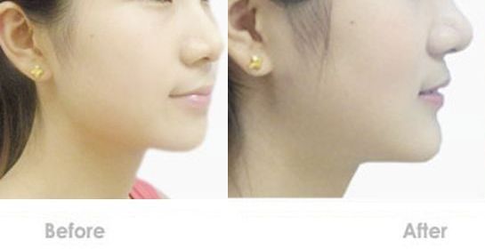 蘇州嘴唇改薄哪家醫(yī)院好？專業(yè)的整形醫(yī)院推薦