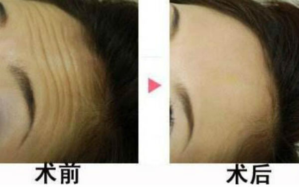 何晉龍的鼻型經(jīng)歷：立體挺拔，妥妥側(cè)顏殺！