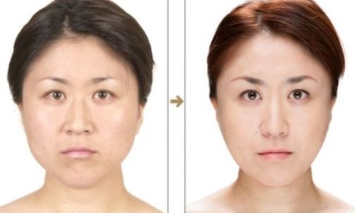 杭州整形醫(yī)院的抽脂效果如何？哪家醫(yī)院抽脂好？