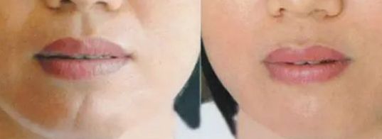 上海面部除疤效果最好的醫(yī)院有哪些？