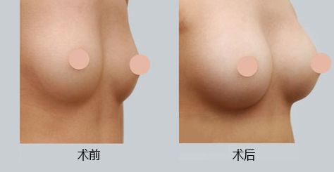 西安墊鼻梁技術(shù)好的醫(yī)院有哪些？