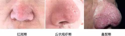解密楊杰雙眼皮修復(fù)失敗案例圖，讓你心中的期望成為現(xiàn)實！
