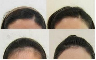 哈爾濱皮秒手術(shù)哪家醫(yī)院好？全面評測哈爾濱皮秒醫(yī)院排名