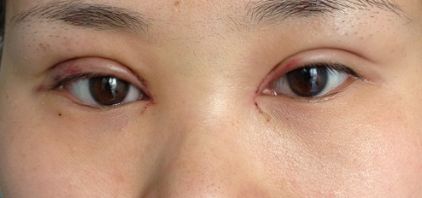 沈陽(yáng)哪家醫(yī)院疤痕手術(shù)效果好？