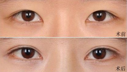 大連假體隆鼻哪家醫(yī)院好？打造完美鼻型，這家醫(yī)院是最佳選擇！