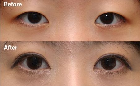 杭州雙眼皮醫(yī)院排名Top1，哪家醫(yī)院做雙眼皮效果好？