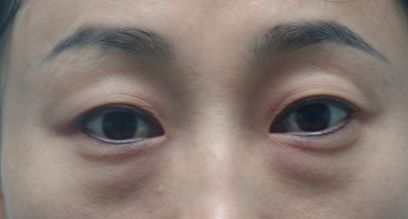 天津醫(yī)院去疤膏效果好的有哪些？