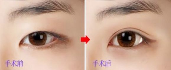 上海玻尿酸豐唇哪家醫(yī)院好？挑選上海口碑好的玻尿酸豐唇醫(yī)院