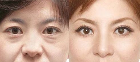 成都做乳暈漂紅哪家好？乳暈漂紅的價格、效果、方法哪種最合適？