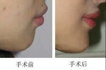 昆明哪家醫(yī)院做上臉下垂手術(shù)好，醫(yī)生技術(shù)靠譜？
