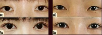 嘟嘟唇無錫哪家醫(yī)院好？專家推薦無錫哪家醫(yī)院治療嘟嘟唇好