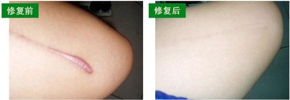 上海微創(chuàng)除皺哪家醫(yī)院好？了解上海微創(chuàng)除皺治療的專業(yè)醫(yī)院推薦