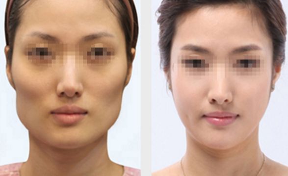 長春雙眼皮修復(fù)好的醫(yī)院有哪些？