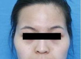 成都治療臉上痘痘哪家醫(yī)院好？專家推薦的成都治痘好醫(yī)院大揭秘！