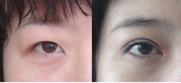 上海市激光修復(fù)痘坑效果如何？哪家醫(yī)院技術(shù)更好？