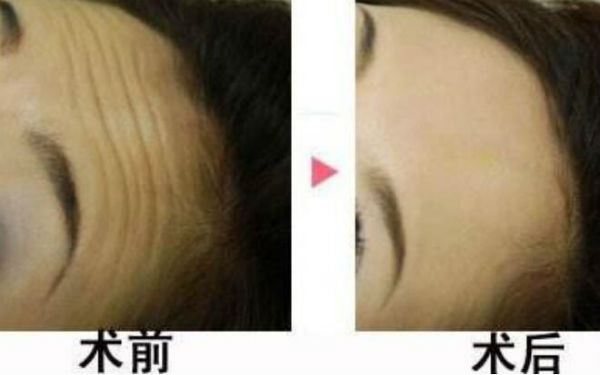 揭秘北京隆鼻領(lǐng)域的專家陳育哲、連凱峰等五位口碑扎實(shí)的權(quán)威專家