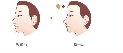 上海翡立思醫(yī)療陳立彬：無痛吸脂撇開隱患，告別粗腿不再是夢