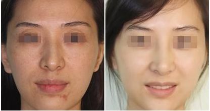 沈陽眼袋整形哪家醫(yī)院好？