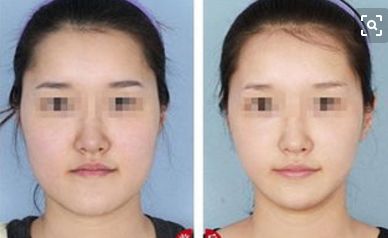 美容拉皮手術(shù)費用受這3個因素影響，術(shù)前必看攻略大揭秘