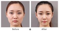 矯正牙齒需預(yù)估費(fèi)用？費(fèi)用注意事項(xiàng)解析！