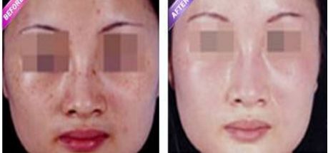激光縮陰是否會導致副作用？找到安全有效的解決方法