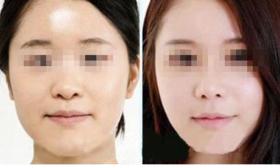激光去除眼袋，持久效果有多久？價格如何，眼周抗衰秘笈大揭示