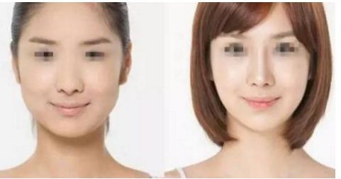 威寧隆胸手術(shù)效果如何？術(shù)后持久無需擔心！