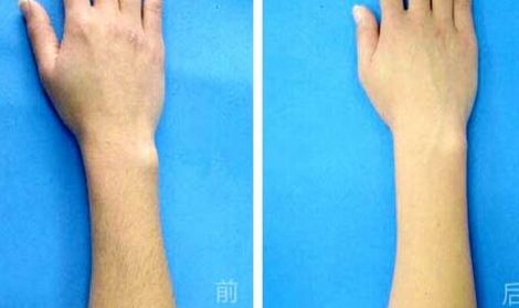 腹部吸脂手術(shù)是否存在副作用？
