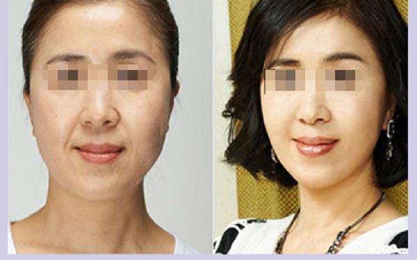 了解烤瓷牙材料，探究?jī)r(jià)格背后的價(jià)值點(diǎn)！