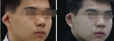 有效解決雙眼皮修復(fù)，手術(shù)方法和時間探究