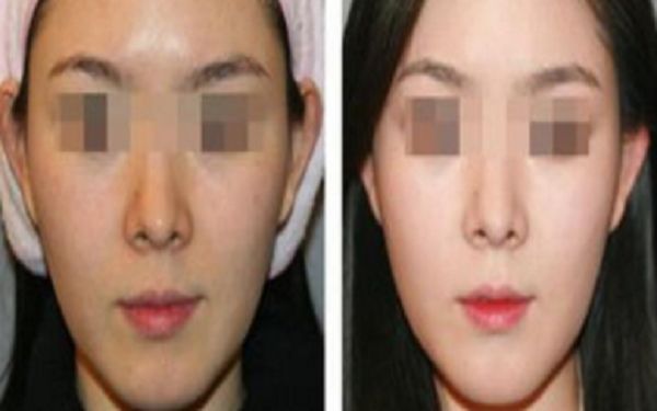 假體隆鼻價(jià)格、效果及相關(guān)信息