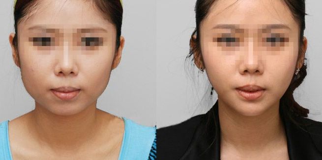低凹鼻梁怎樣通過隆鼻手術(shù)改善？