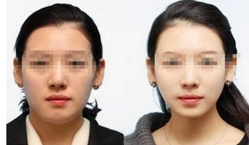 彩光嫩膚：一個(gè)療程要多少次才有效？
