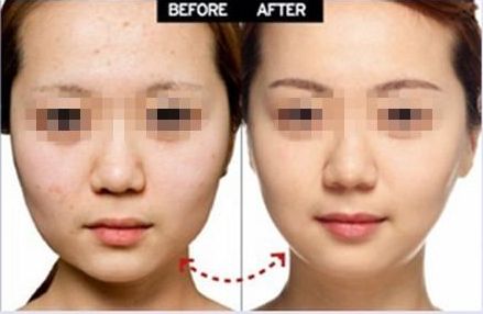 開外眼角手術(shù)：提升臥蠶、增大眼睛，效果有多好？