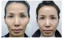 SMAS除皺是安全高效的解決皺紋問題的神奇術