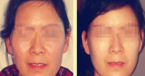 opt光子嫩膚費(fèi)用及價(jià)格查詢?cè)斀?，了解opt光子嫩膚真實(shí)價(jià)格與口碑評(píng)價(jià)
